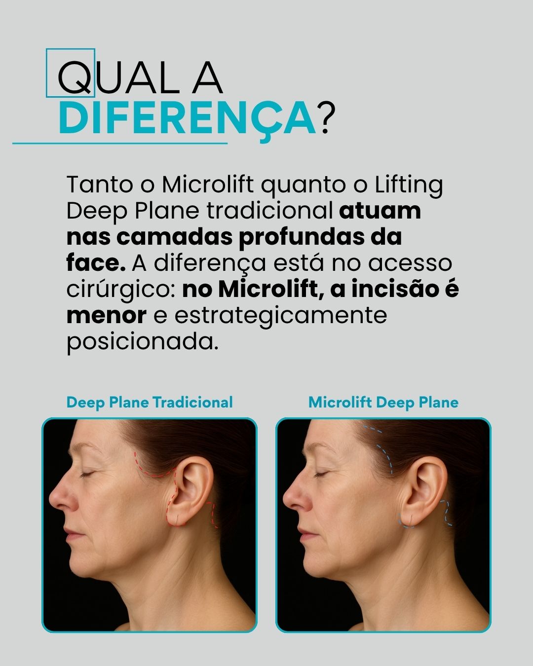 Qual a diferença? Tanto o Microlift quanto o Lifting Deep Plane tradicional atuam nas camadas profundas da face. A diferença está no acesso cirúrgico: no Microlift, a incisão é menor e estrategicamente posicionada.