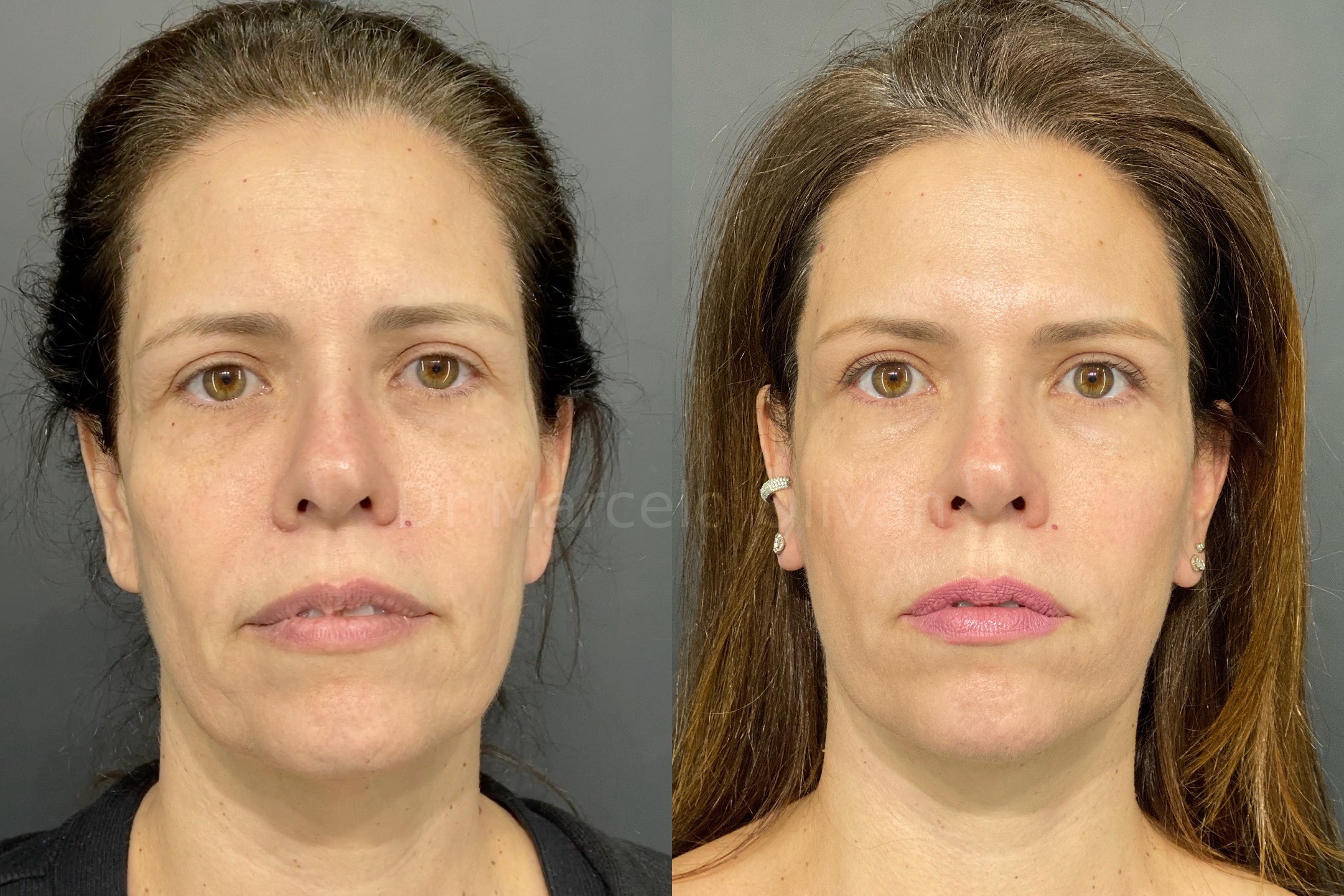 Antes e depois - visão frontal