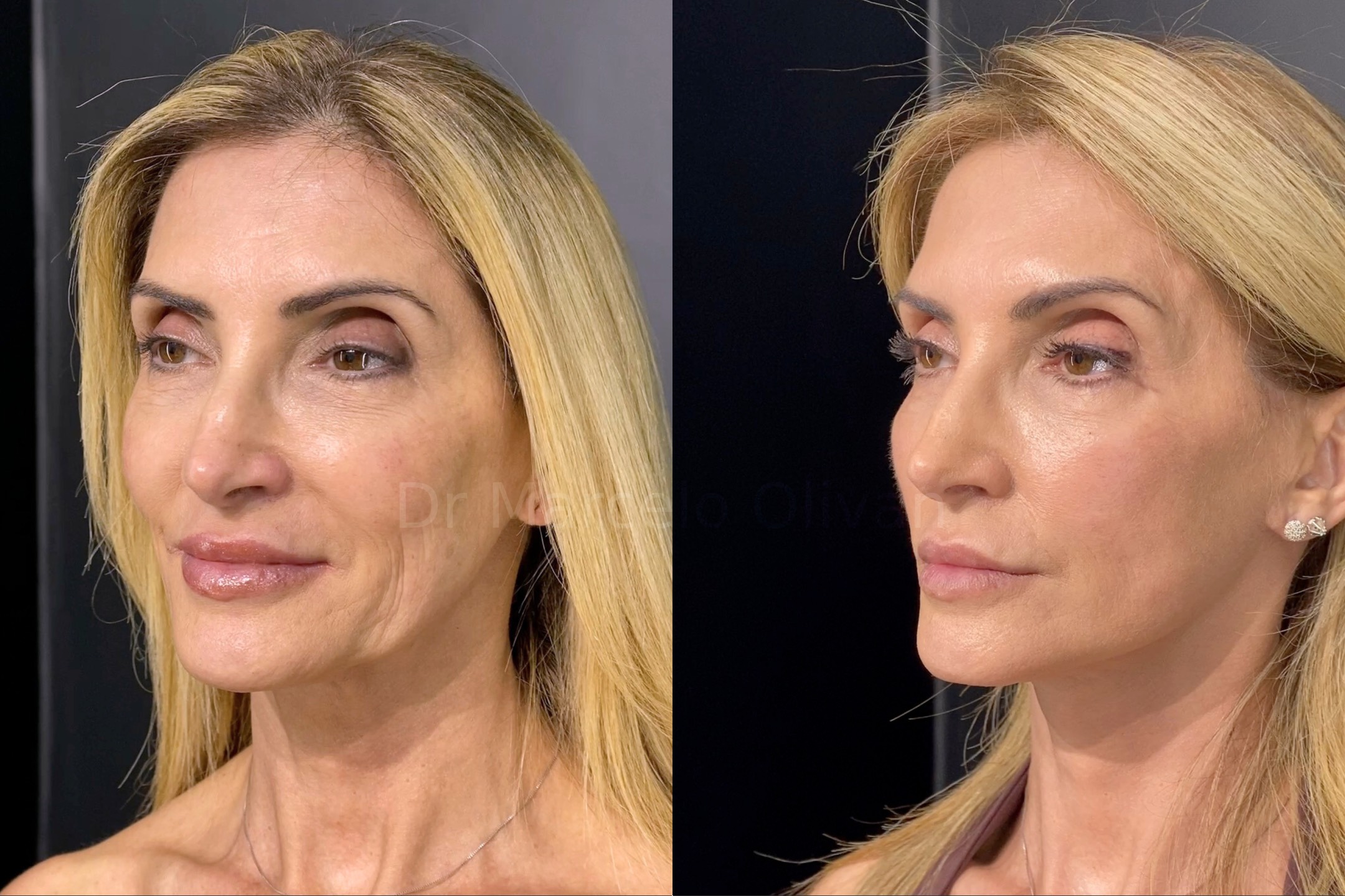 Resultado Gisele - Visão Angular