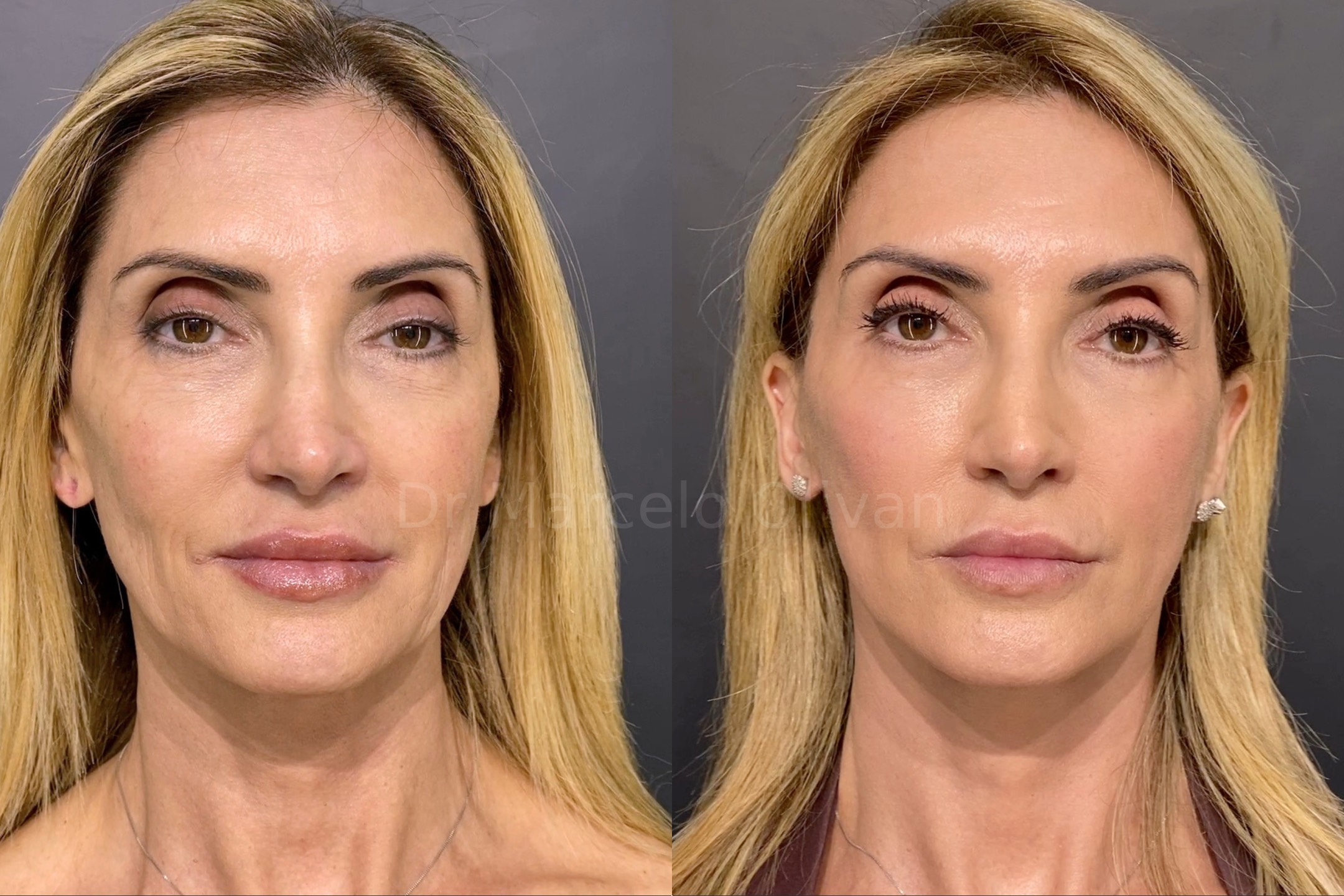 Antes e depois - visão frontal