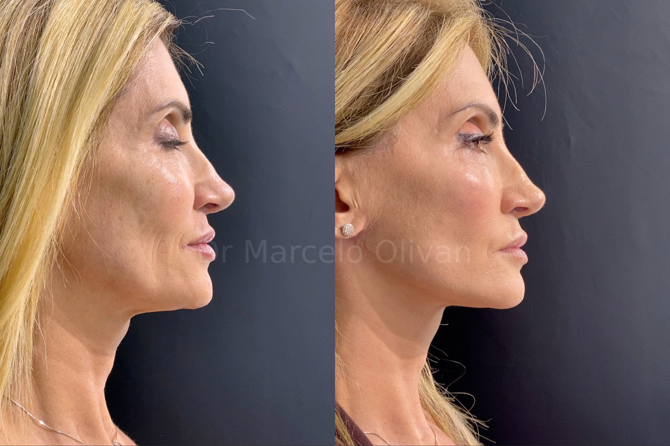 Resultado Gisele - Visão Lateral