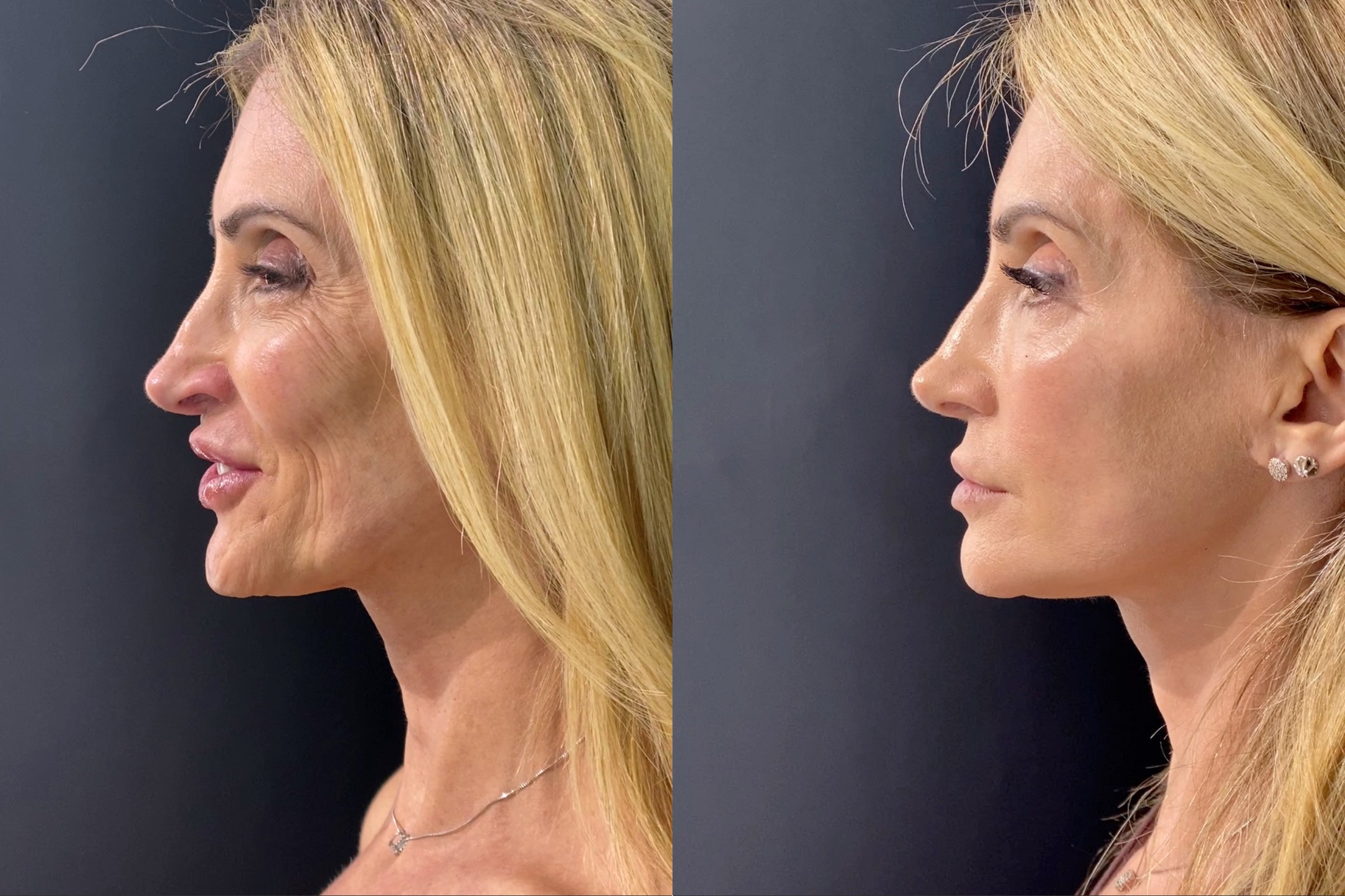 Antes e depois - visão angular