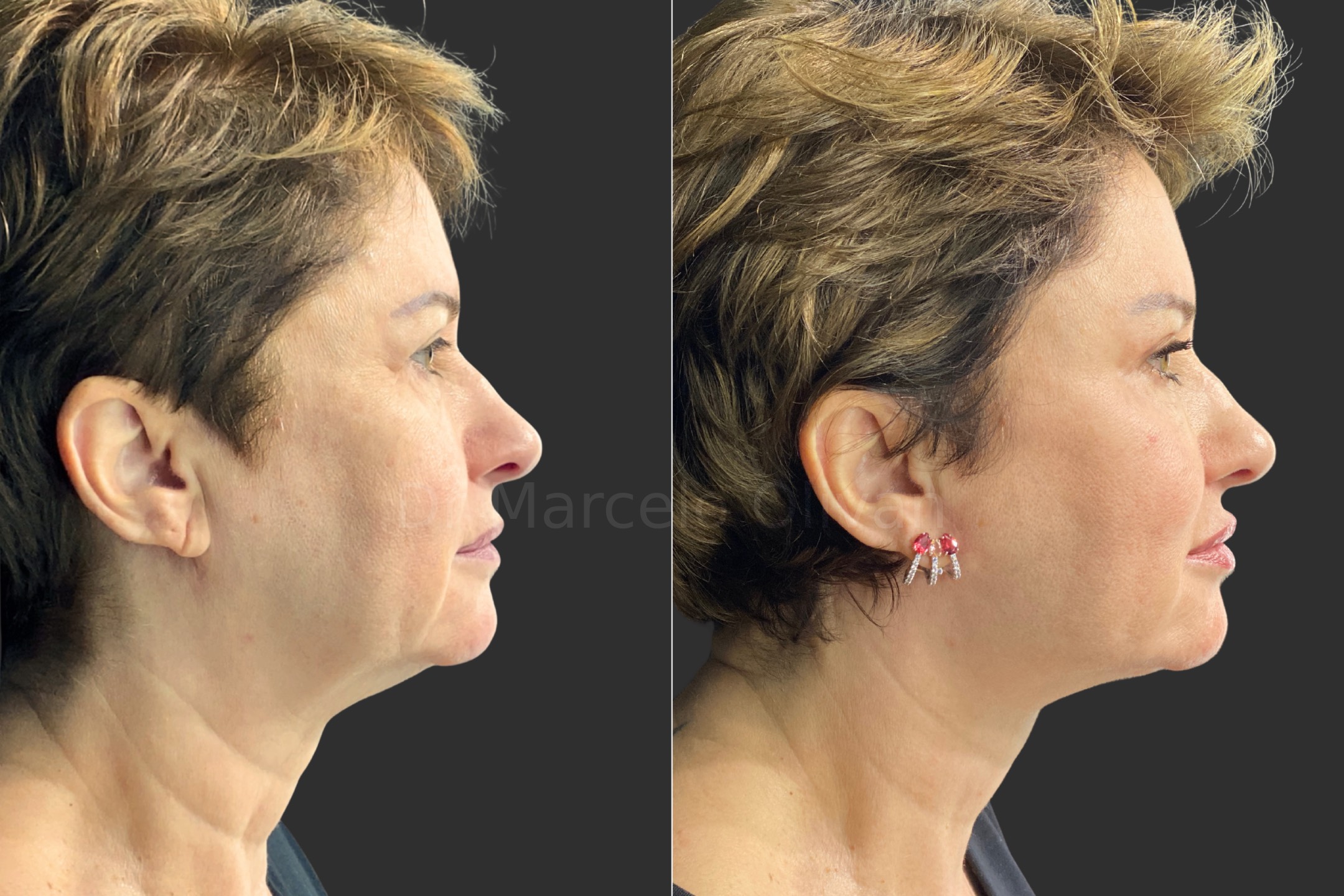 Antes e depois - visão lateral direita