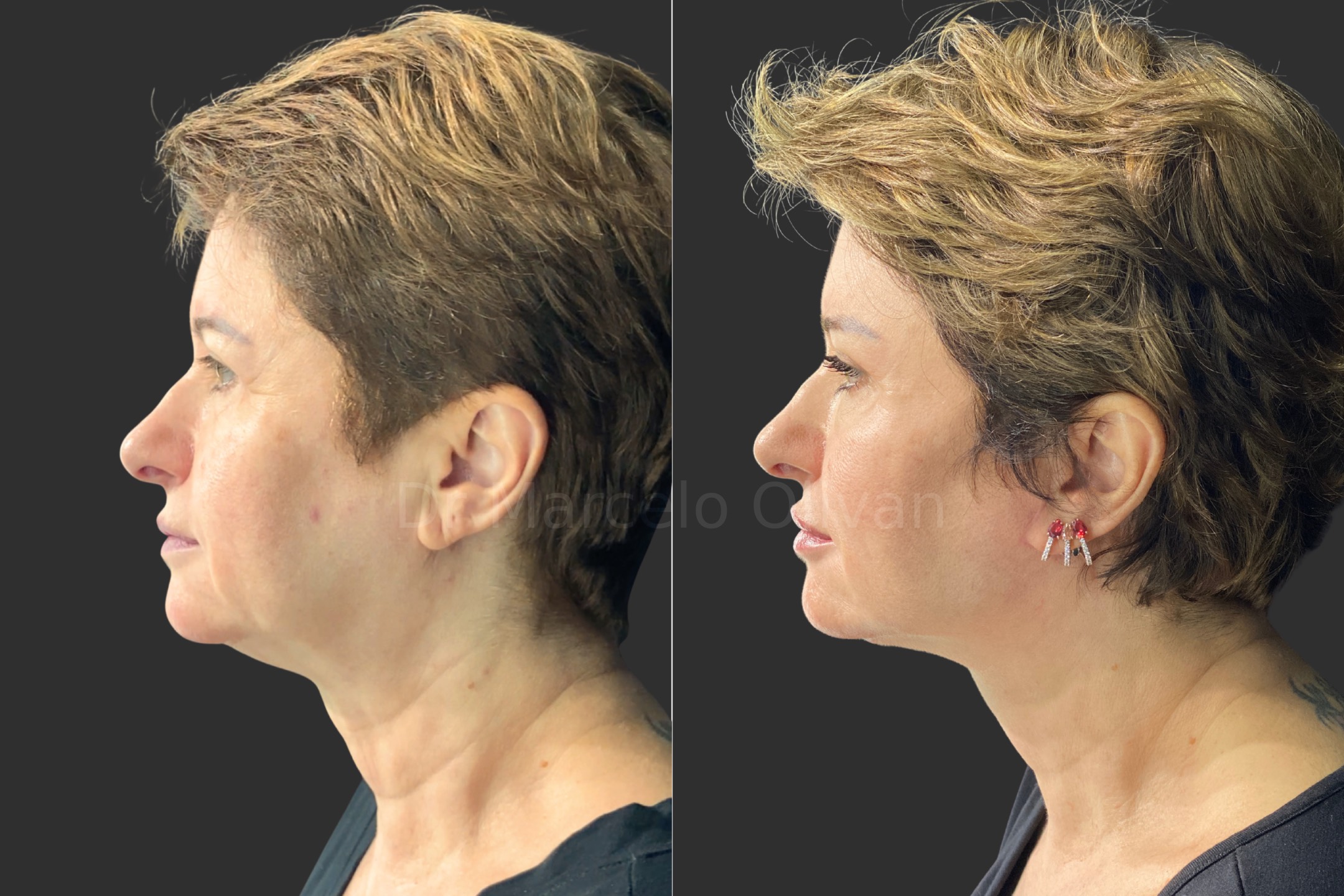 Antes e depois - visão lateral esquerda