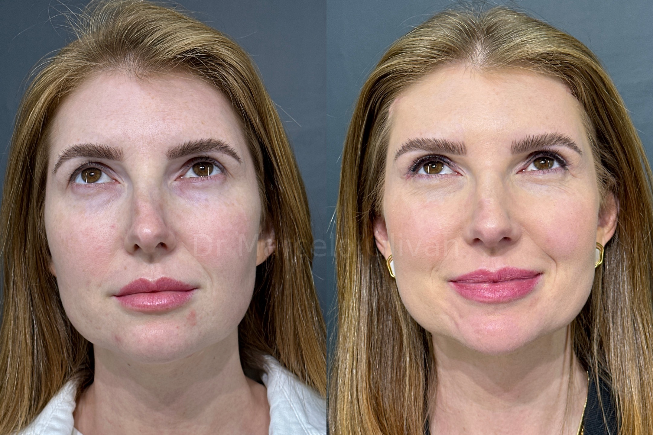 Antes e depois - visão frontal