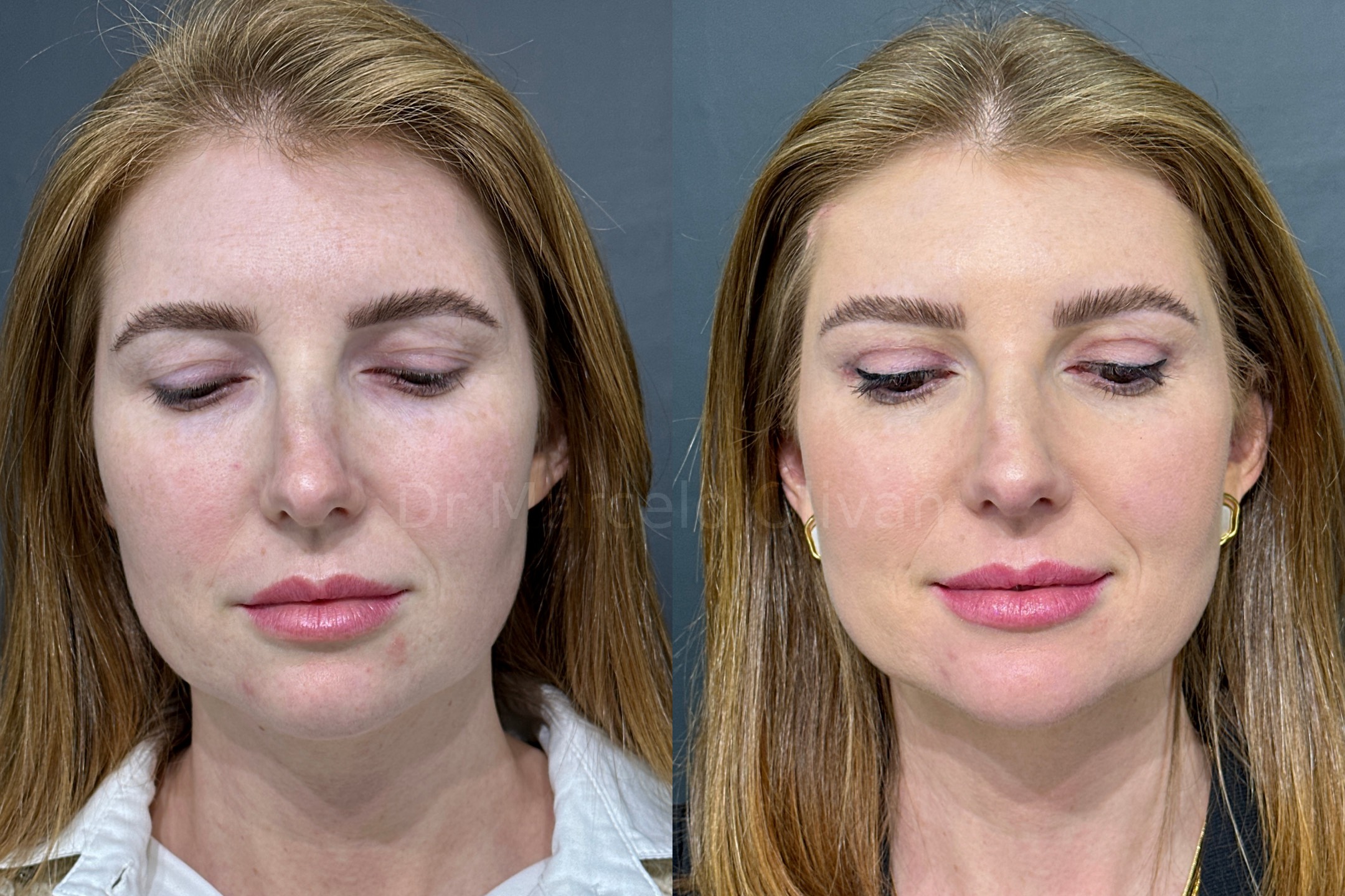 Antes e depois - visão frontal