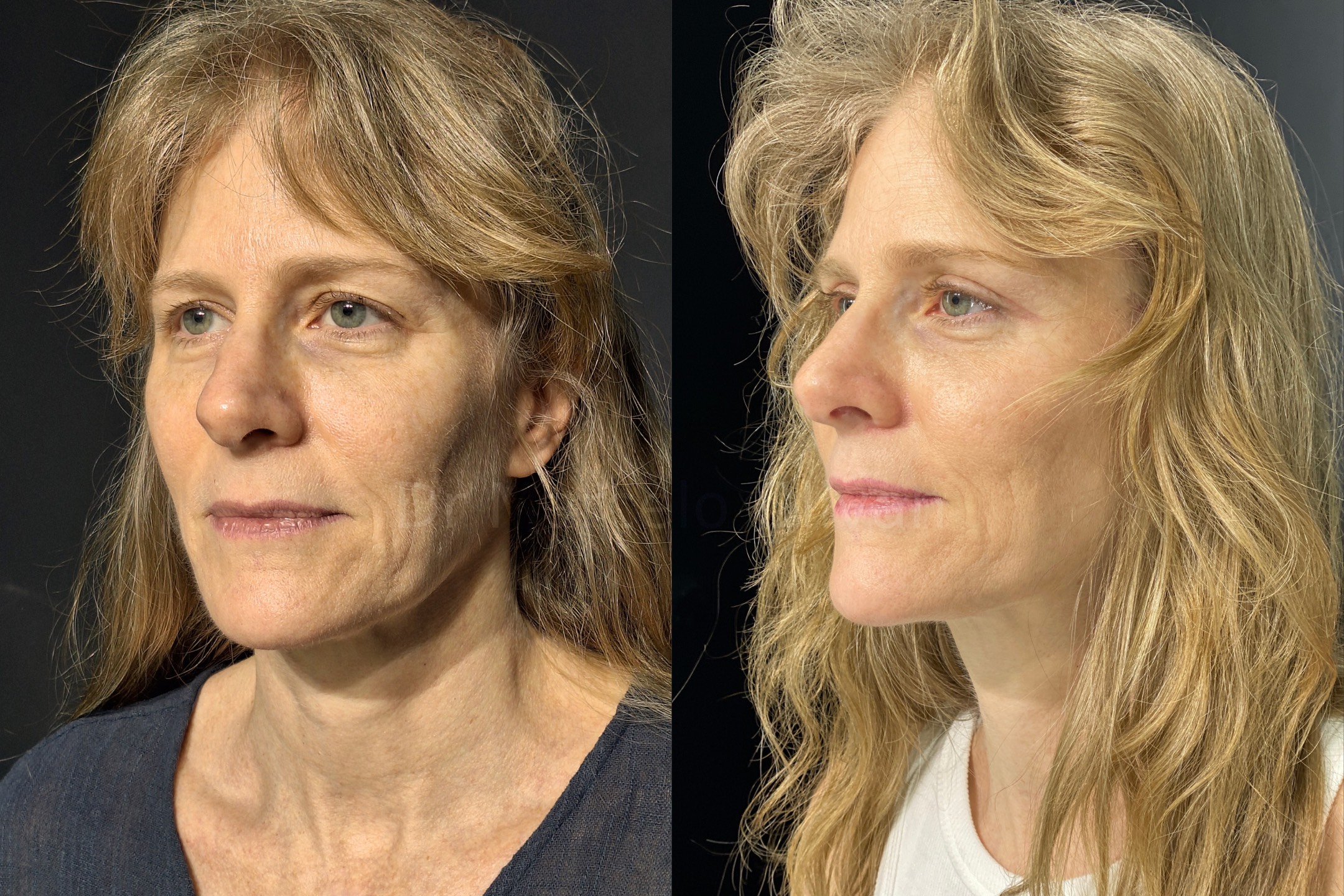 Antes e depois - visão angular