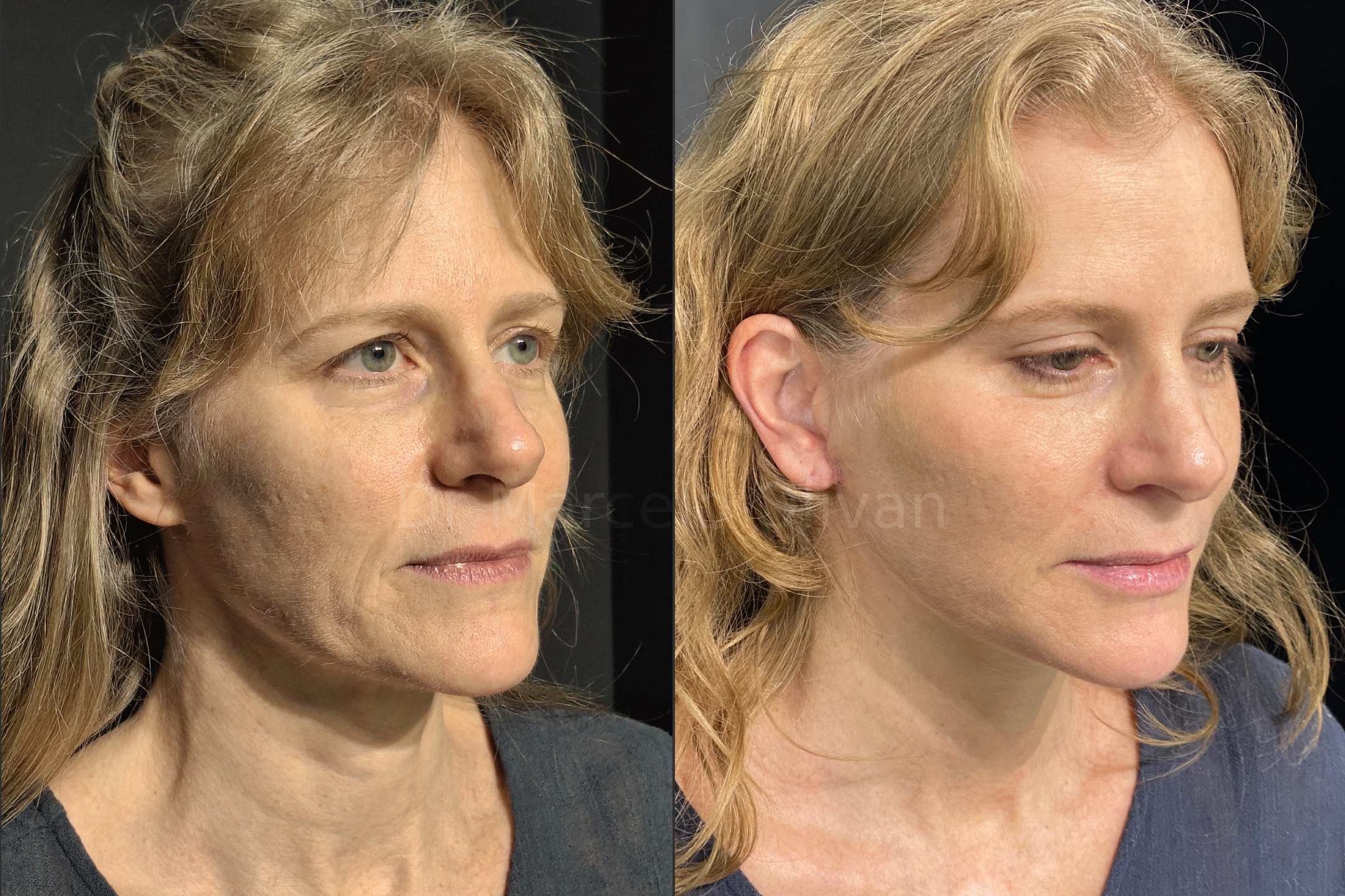 Antes e depois - visão angular