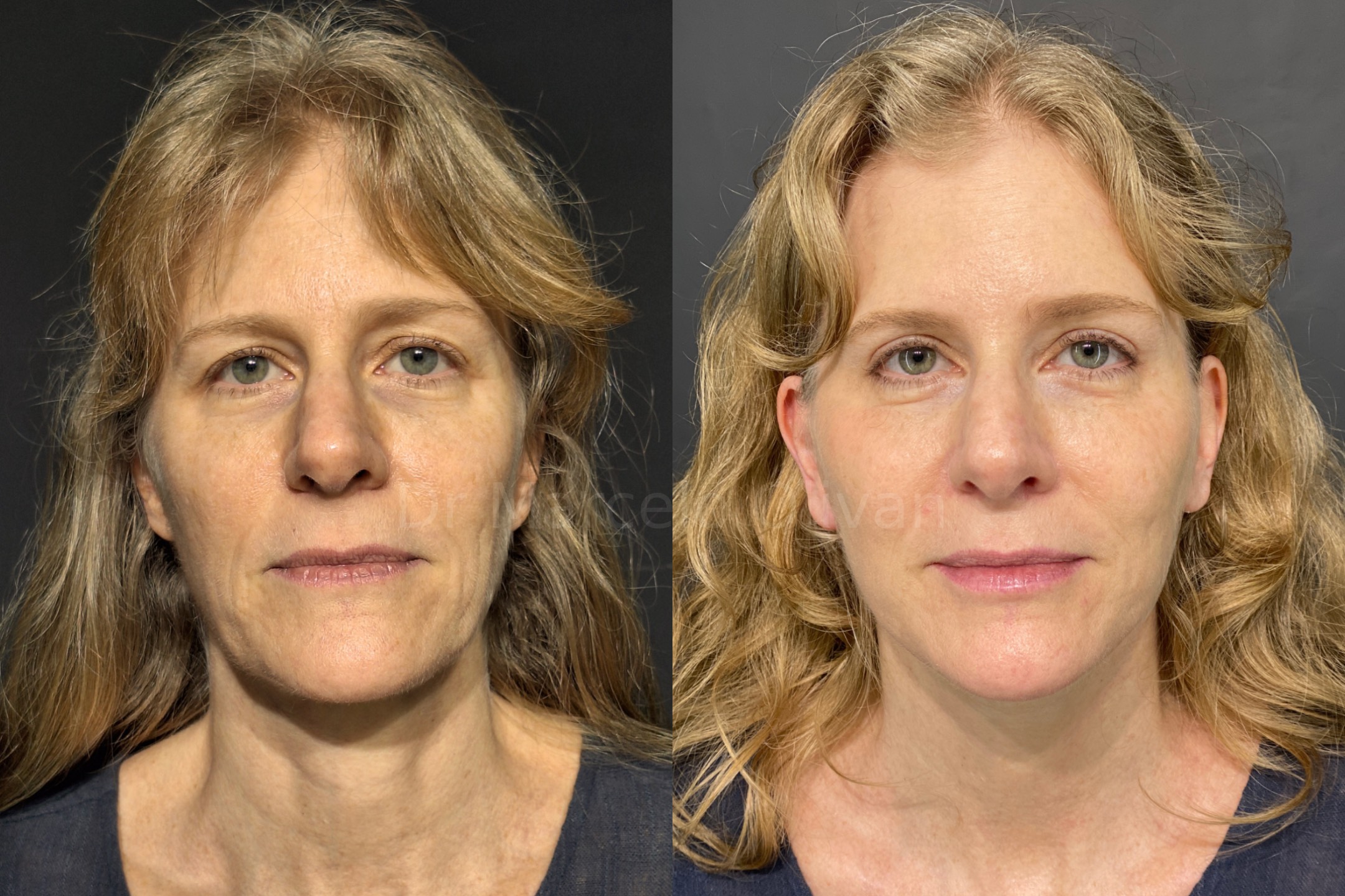 Antes e depois - visão frontal