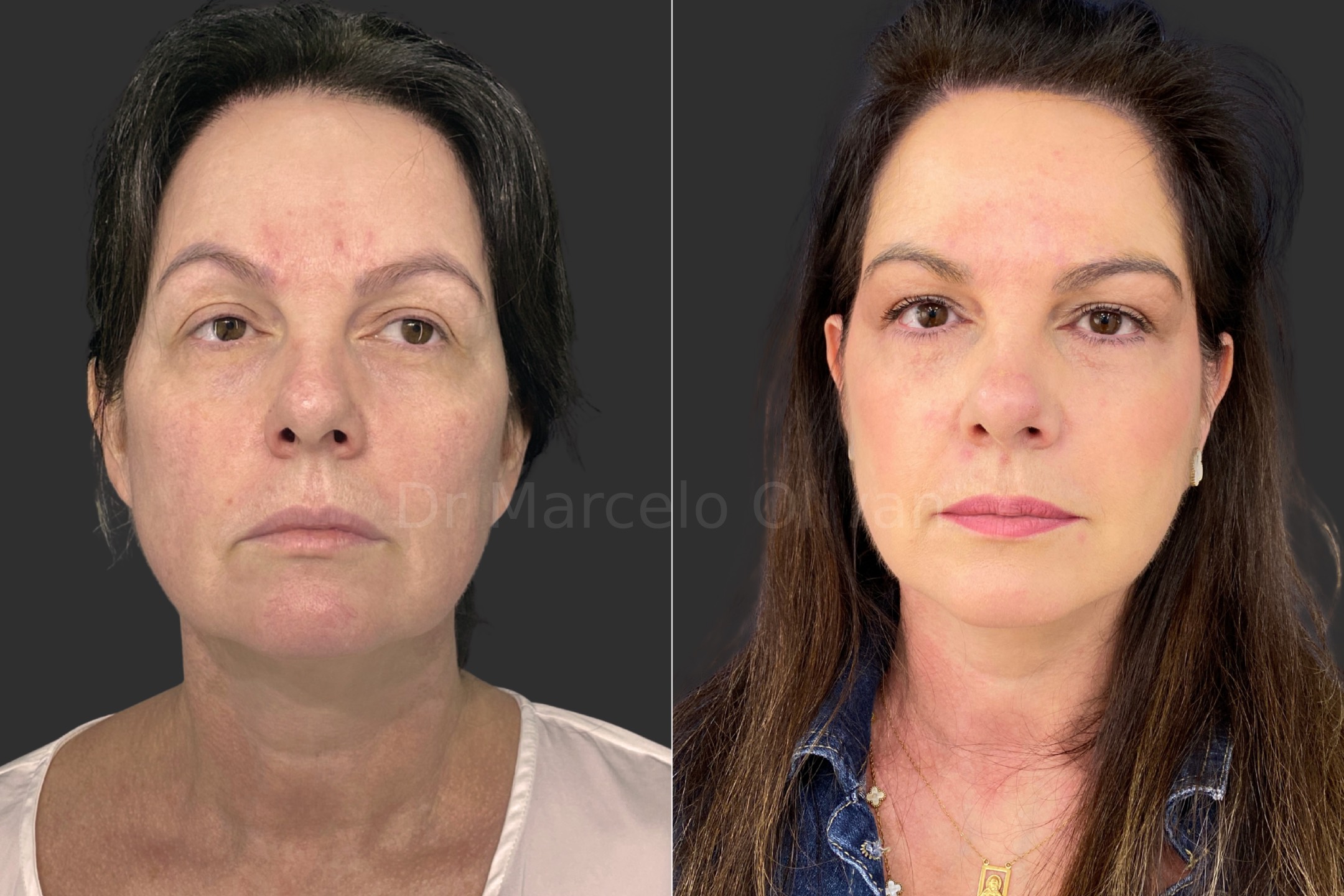 Antes e depois - visão frontal