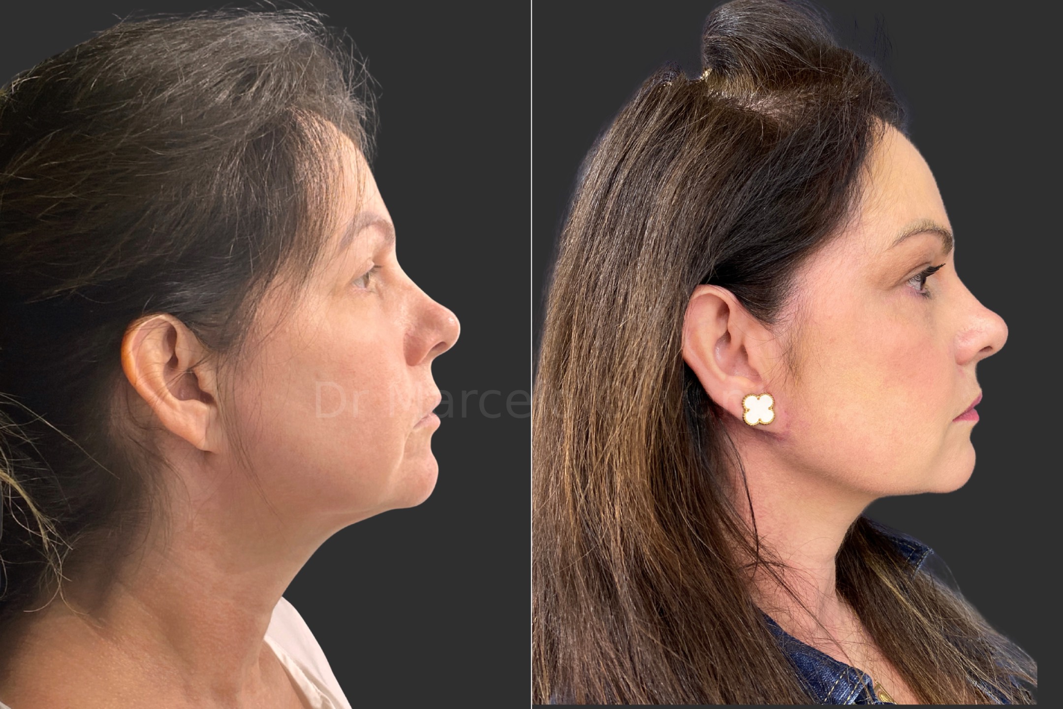 Antes e depois - visão lateral